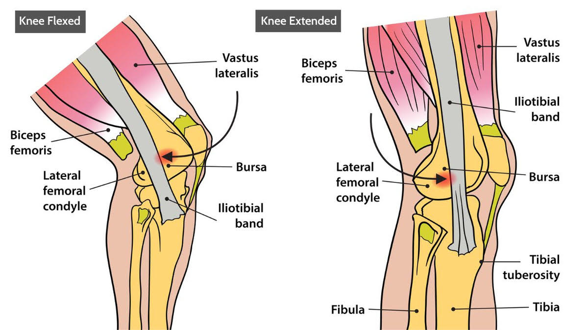 Iliotibial IT Band Syndrome