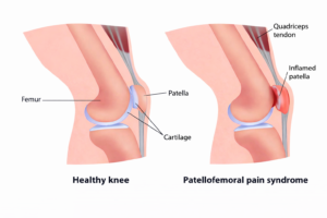 Patellofemoral Pain Syndrome (PFPS)