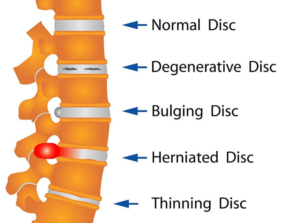What Causes Lower Back Pain? A Physiotherapist Explains 3 Diagram showing a bulging and herniated disc causing lower back pain
