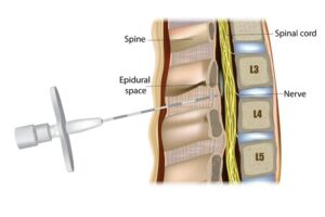 Epidural Steroid Injections