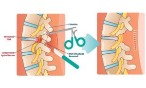 Laminectomy